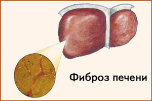 Гепатит С смертельно