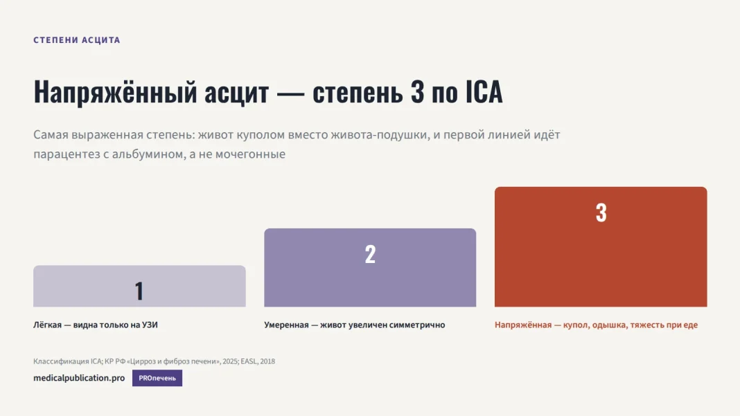 Шкала трёх степеней асцита по ICA, третья степень выделена тревожным цветом