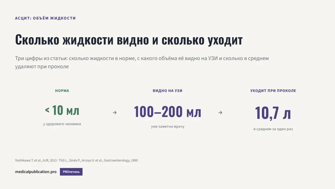 Три цифры объёма жидкости при асците: менее 10 мл в норме, 100–200 мл видно на УЗИ, 10,7 литра уходит при проколе
