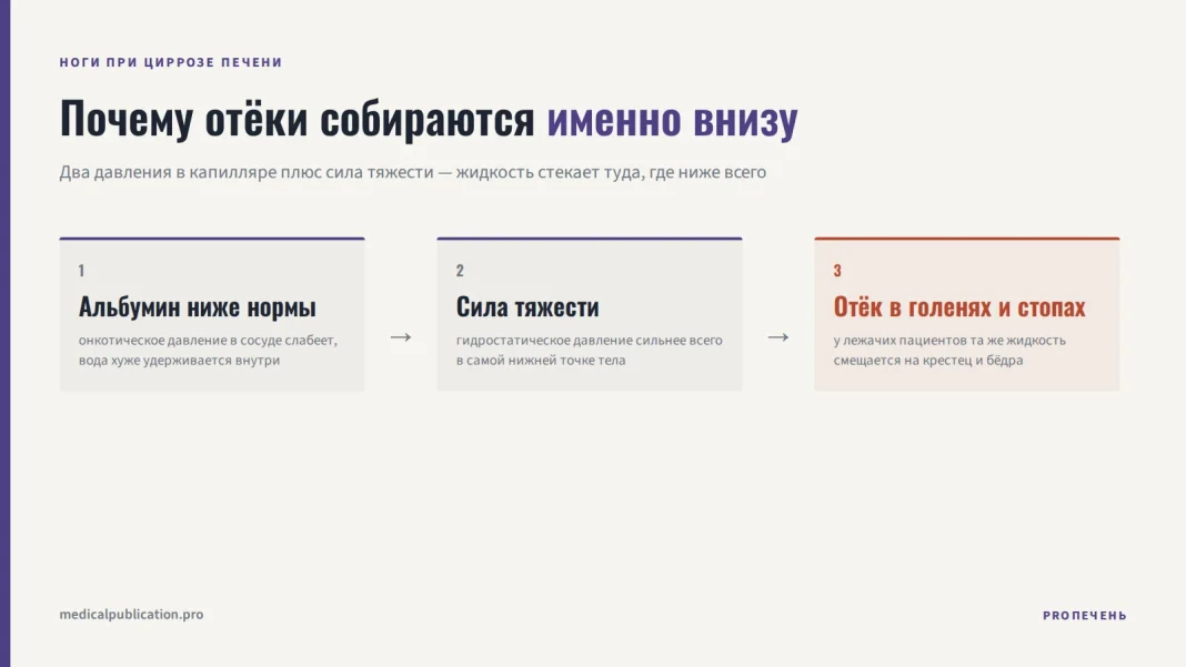 Схема из трёх шагов: альбумин ниже нормы ослабляет онкотическое давление, сила тяжести тянет жидкость вниз, в итоге отёк появляется в голенях и стопах