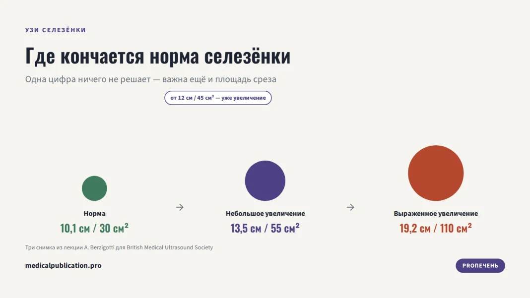 Три кружка возрастающего размера — норма, небольшое и выраженное увеличение селезёнки с длиной и площадью среза по УЗИ